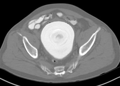 Record Size Bladder Stone Removal