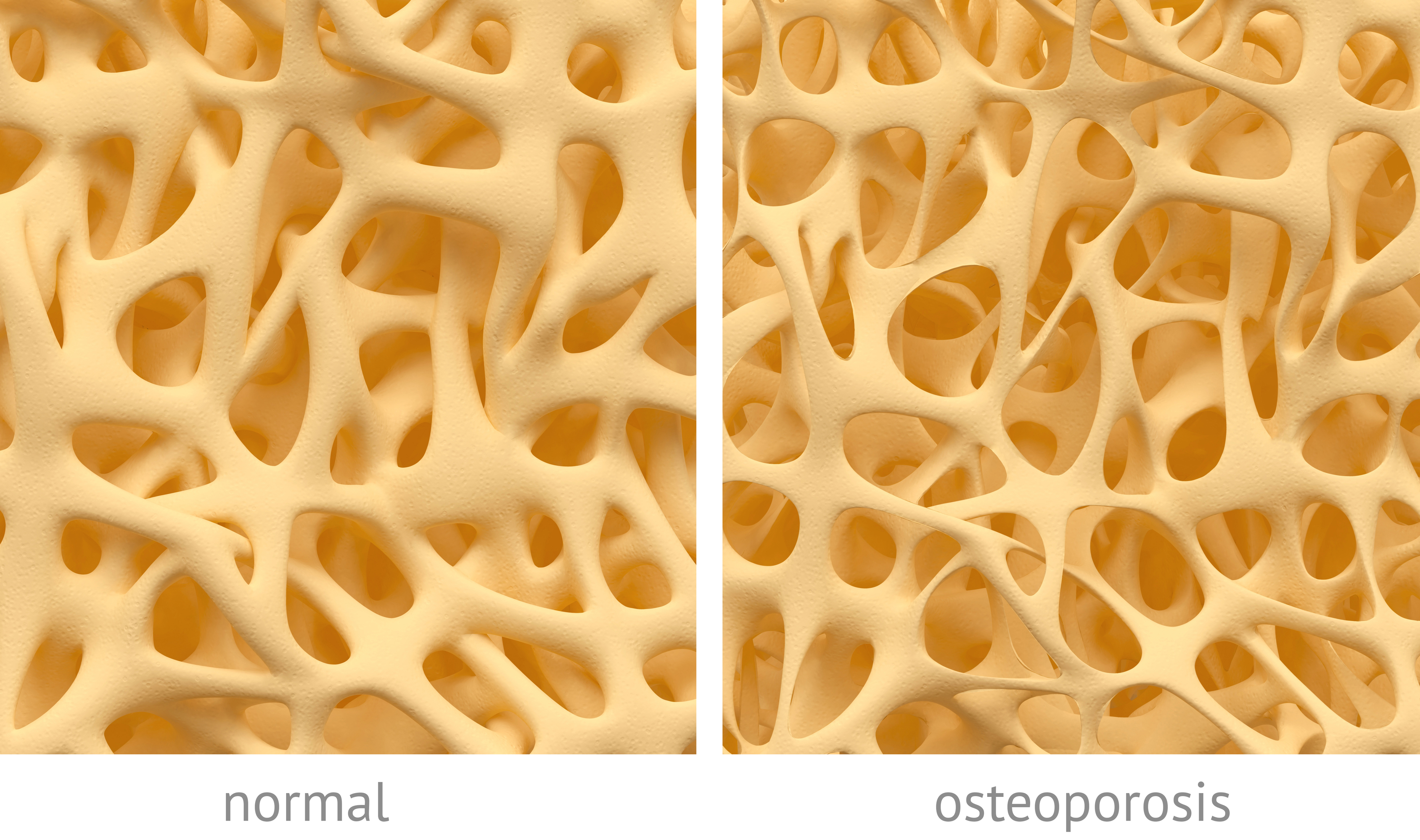 Osteoporosis - event type